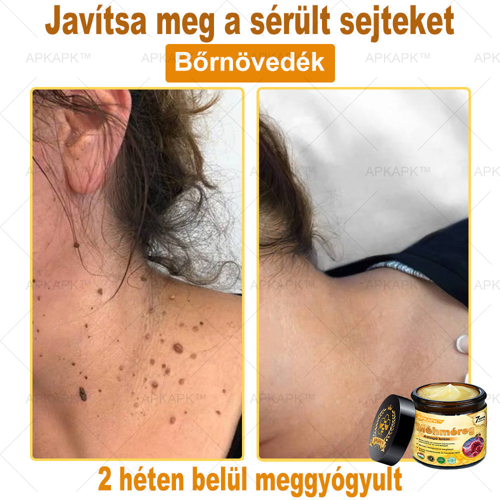 𝐀𝐏𝐊𝐀𝐏𝐊® 𝐌É𝐇𝐌É𝐑𝐄𝐆 Á𝐓𝐅𝐎𝐆Ó 𝐊𝐑É𝐌🥇𝐀 𝐛ö𝐫𝐩𝐫𝐨𝐛𝐥é𝐦á𝐤 𝐤𝐞𝐳𝐞𝐥é𝐬𝐞 𝐦𝐚𝐠á𝐛𝐚𝐧 𝐟𝐨𝐠𝐥𝐚𝐥𝐣𝐚: é𝐥𝐞𝐭𝐤𝐨𝐫𝐢 𝐟𝐨𝐥𝐭𝐨𝐤, 𝐡𝐞𝐠𝐞𝐤, 𝐬𝐳𝐞𝐦ö𝐥𝐜𝐬ö𝐤, 𝐛ö𝐫𝐧ö𝐯𝐞𝐝é𝐤𝐞𝐤, 𝐭á𝐥𝐲𝐨𝐠𝐨𝐤, 𝐩𝐚𝐭𝐭𝐚𝐧á𝐬𝐨𝐤, 𝐞𝐤𝐜é𝐦𝐚, 𝐩𝐬𝐨𝐫𝐢𝐚𝐬𝐢𝐬, 𝐚𝐜𝐧𝐞 𝐢𝐧𝐯𝐞𝐫𝐬𝐚, 𝐫á𝐧𝐜𝐨𝐤, 𝐛ö𝐫ö𝐫𝐞𝐠𝐞𝐝é𝐬 é𝐬 𝐞𝐠𝐲é𝐛 𝐩𝐫𝐨𝐛𝐥é𝐦á𝐤🔥